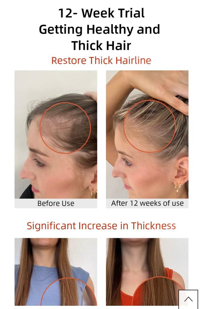 Before and after results of a 12-week trial showing significant improvement in hair thickness and restored hairline with Vida Glow Hairology Advanced Repair.